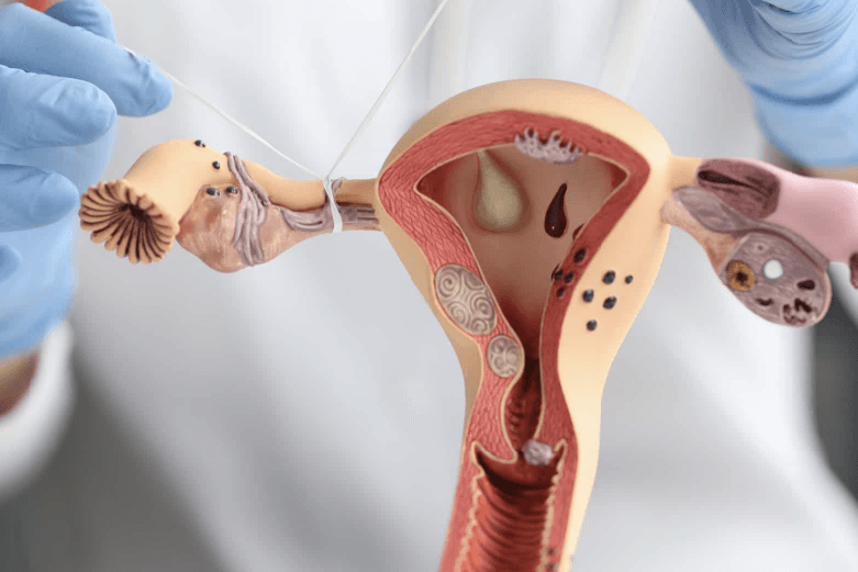 what is tubal ligation