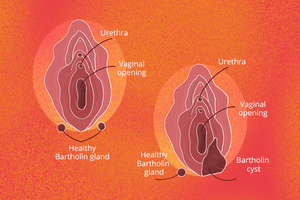 Bartholin’s Cyst: What is This Lump Near My Vaginal Opening